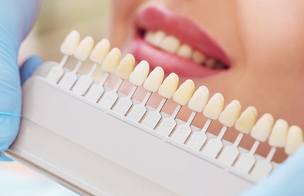 Fazer clareamento dentário antes ou depois do tratamento